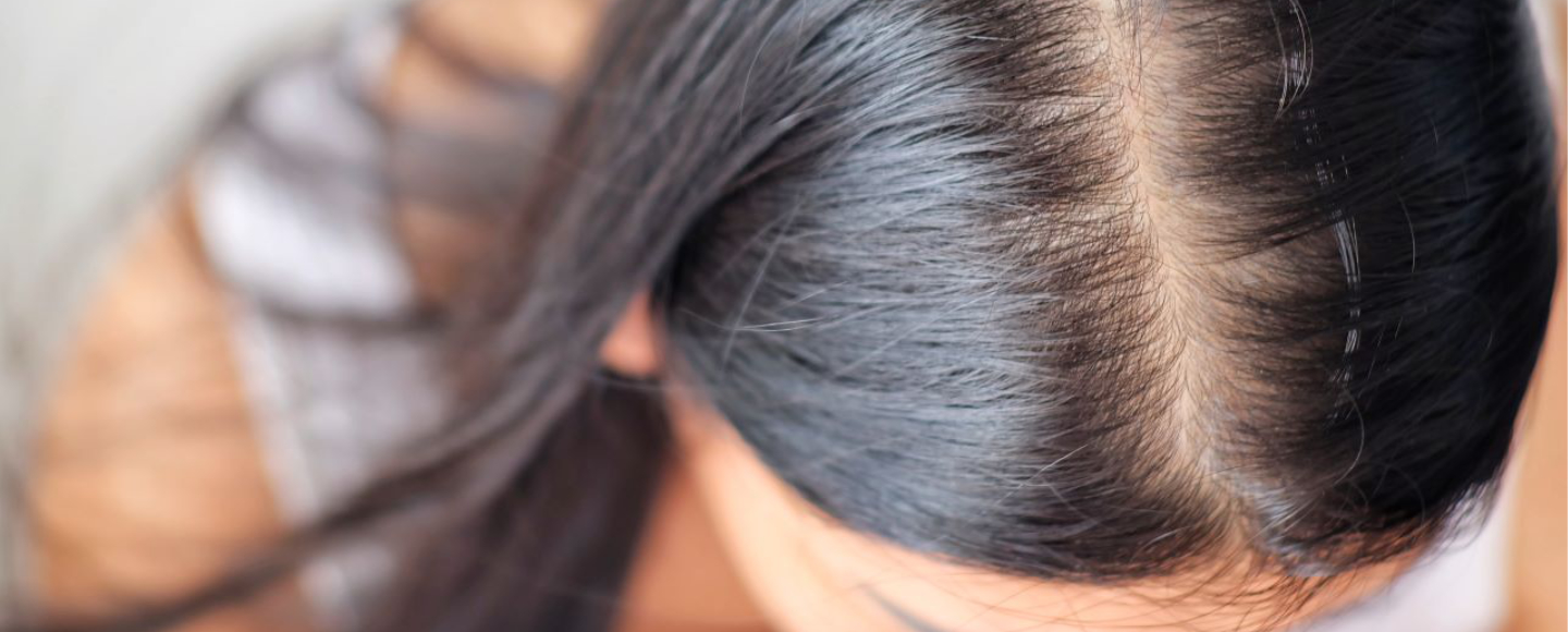 How Do You Know If Your Hairline Is Receding?